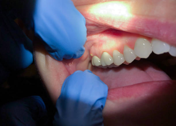 Best Broken or Cracked Tooth Emergency Dentist in The Hills, TX